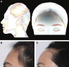 augmentation-of-type-V-inclined-slope-forehead-Schematic-of-inclined-slope-forehead.ppm.png